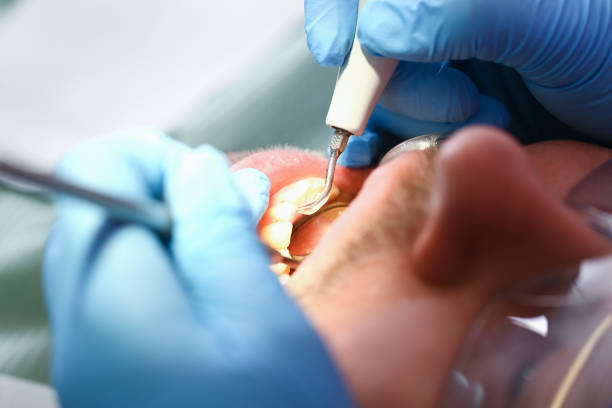 Best Emergency Treatment for Dental Infections or Abscesses in Santa Rita Ranch, TX