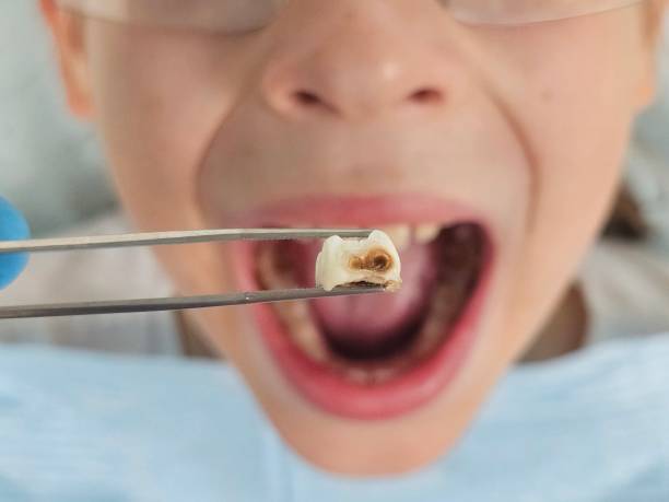 Best Emergency Dental Care for Broken or Chipped Teeth in Santa Rita Ranch, TX